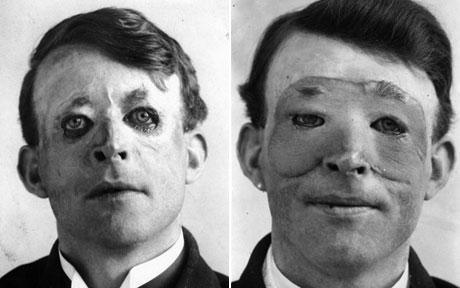 walter_yeo_skin_graft Antik Dönemde Burun Estetiği: Sushruta'nın Bilinmeyen Tıp Mirası